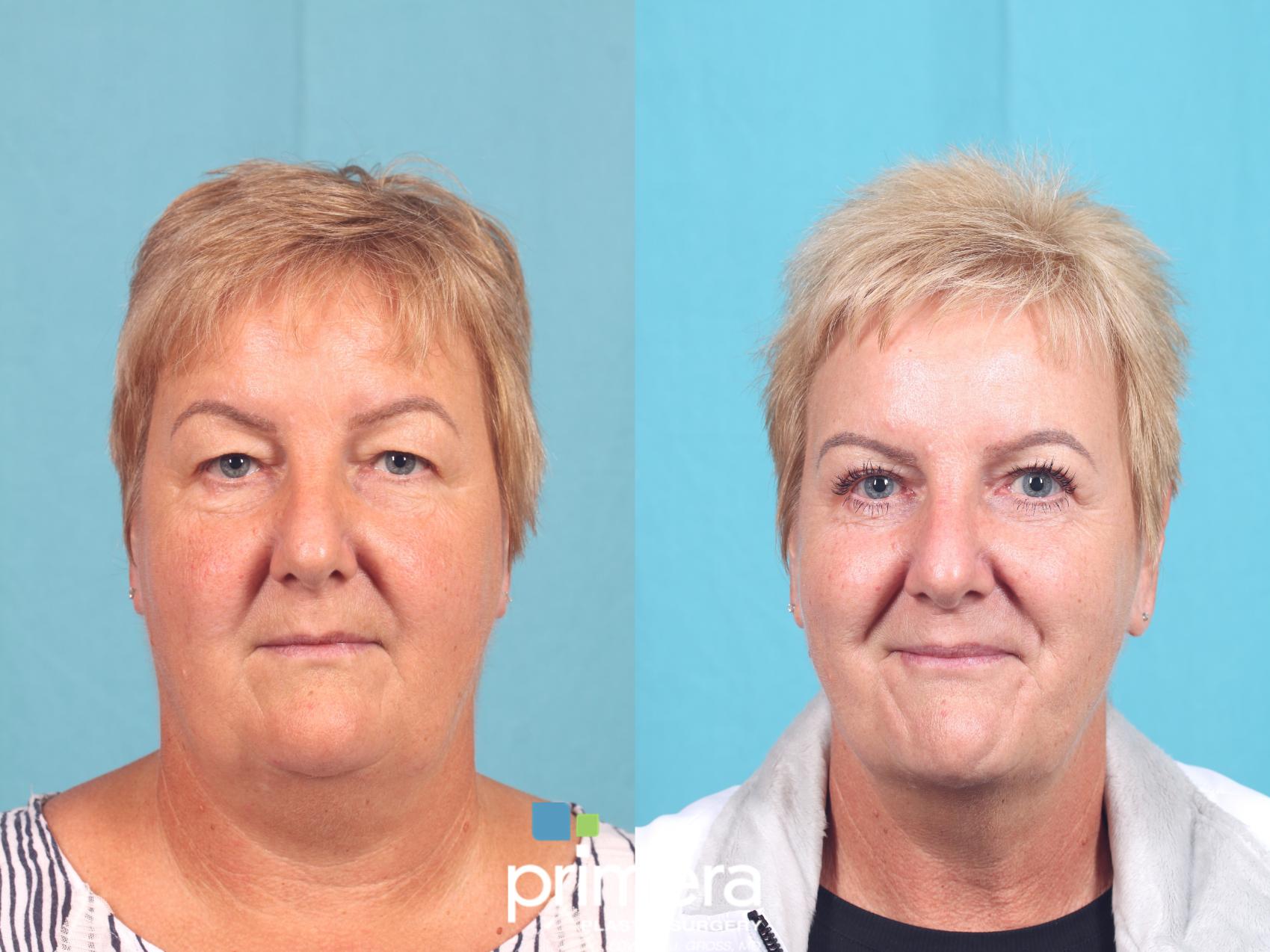 Before & After BOTOX® Cosmetic Case 616 Front View in Orlando, Florida