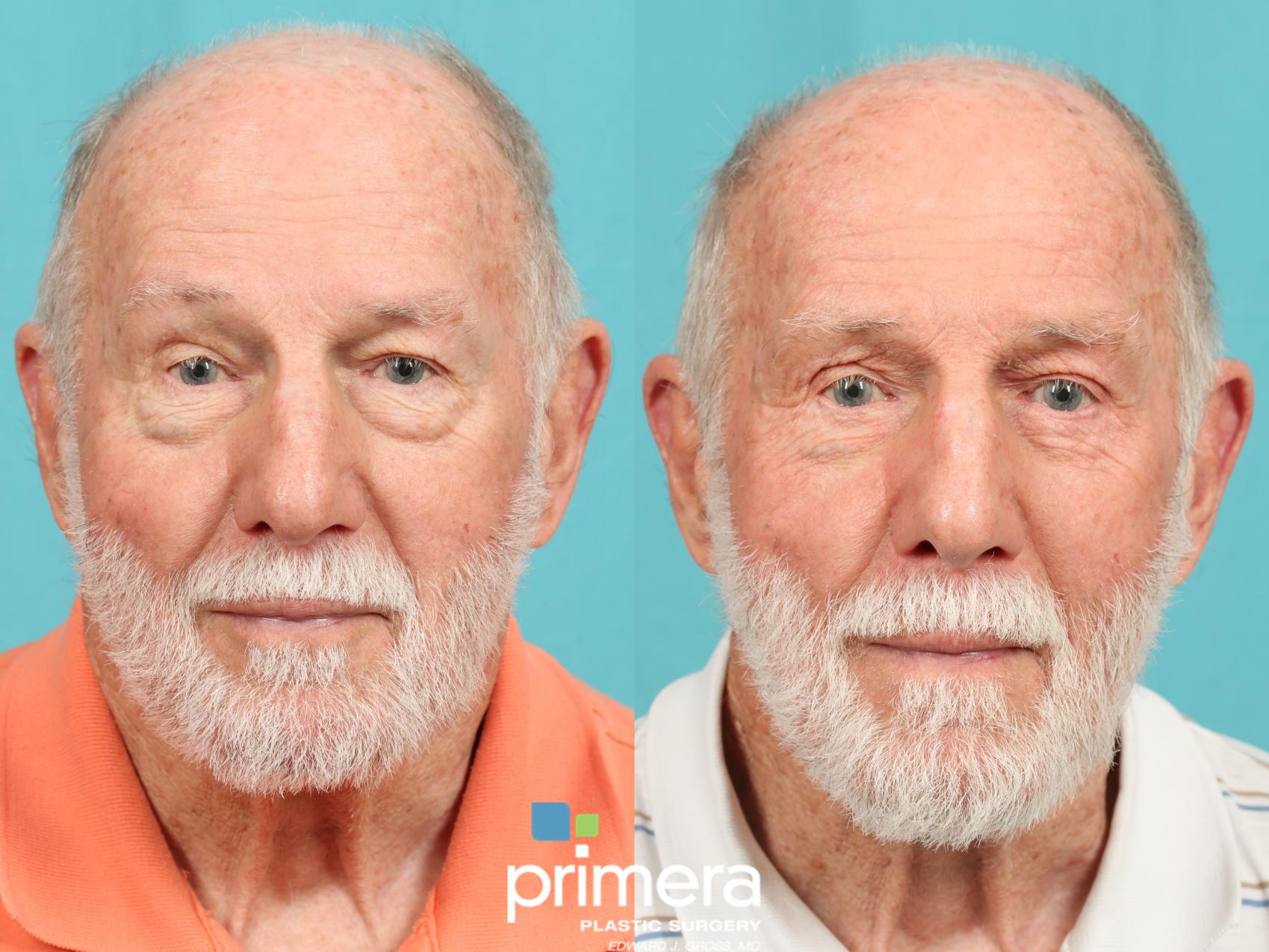 Before & After Surgery for Men Case 644 Front View in Orlando, Winter Park & Tampa, Florida