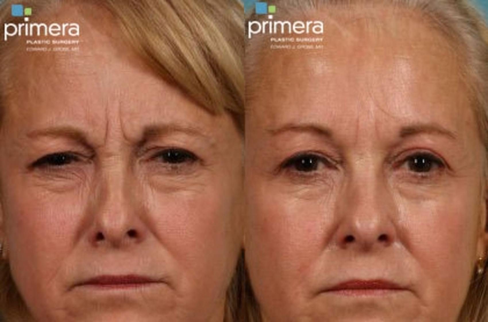 Before & After Blepharoplasty Case 66 view-1 View in Orlando, Florida