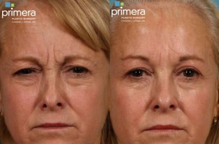 Before & After BOTOX® Cosmetic Case 66 view-1 View in Orlando, Florida
