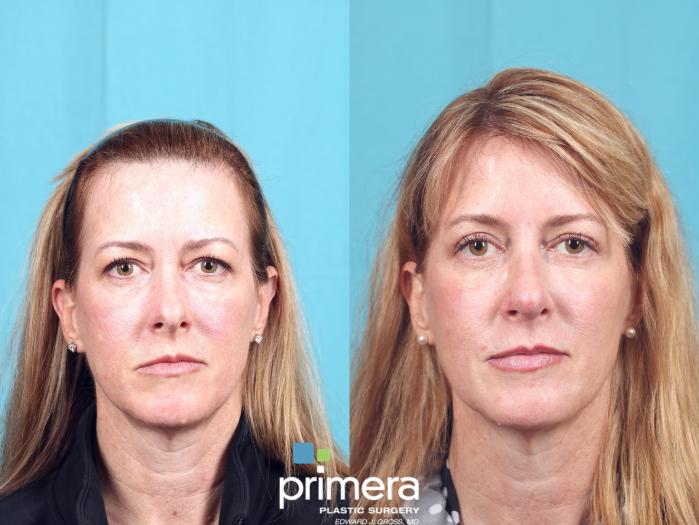 Before & After Dysport® Case 665 Front View in Orlando, Florida