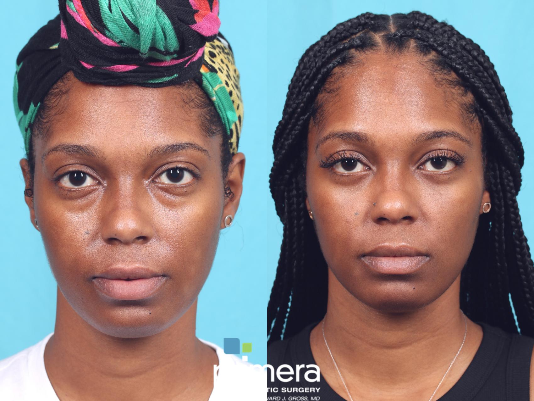 Blepharoplasty before after new arrivals