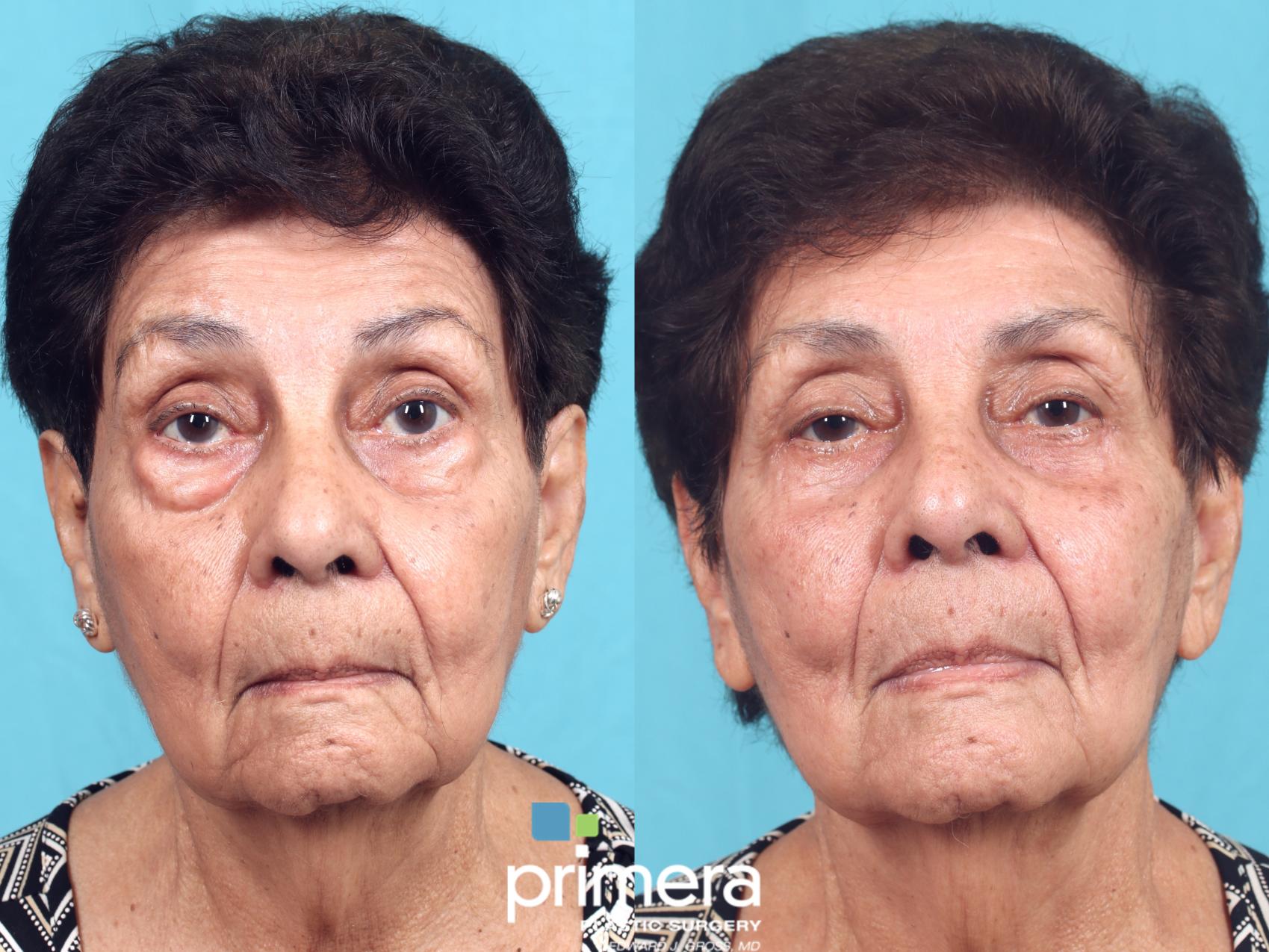 Before & After Blepharoplasty Case 674 Front View in Orlando, Florida