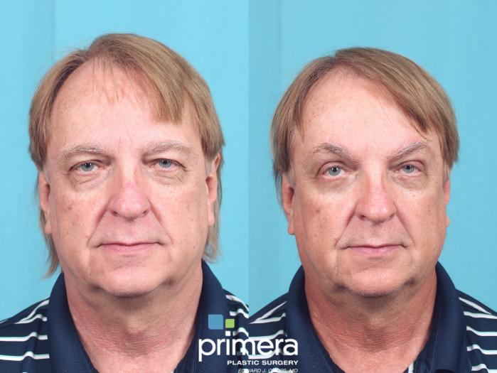 Before & After Blepharoplasty Case 698 Front View in Orlando, Florida