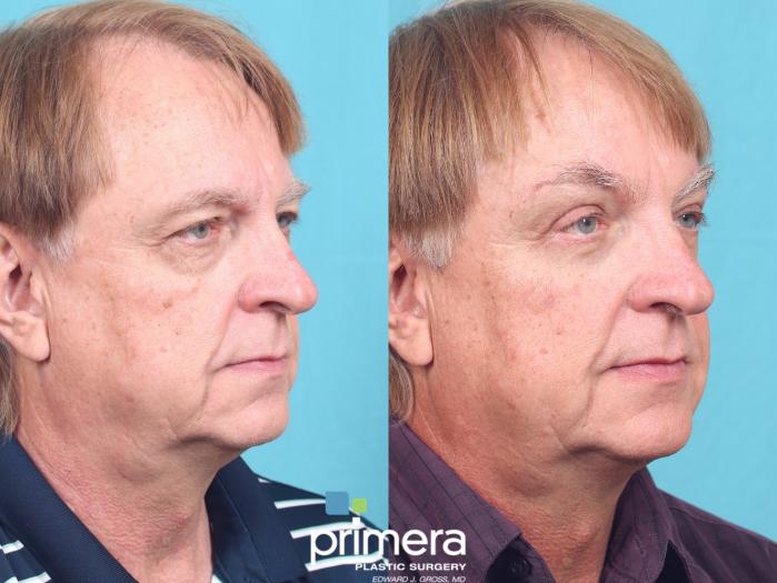 Before & After Blepharoplasty Case 698 Right Oblique View in Orlando, Florida