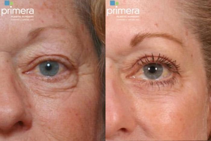 Before & After Blepharoplasty Case 71 view-1 View in Orlando, Florida