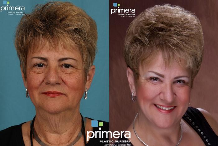 Before & After Blepharoplasty Case 72 view-1 View in Orlando, Florida