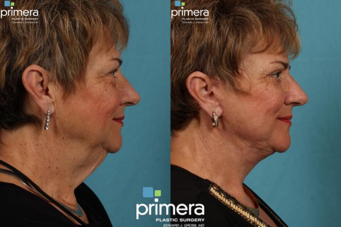 Before & After Facelift Case 72 view-2 View in Orlando, Florida
