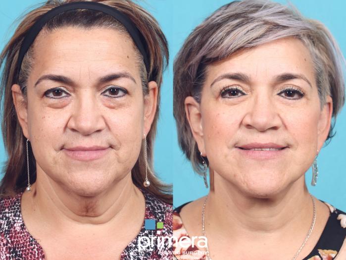 Before & After Facelift Case 760 Front View in Orlando, Florida