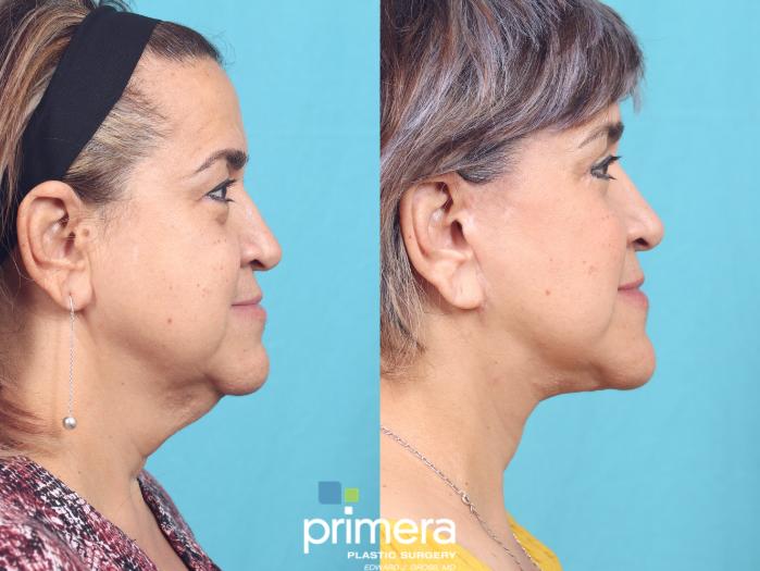 Before & After Neck Lift Case 760 Right Side View in Orlando, Florida
