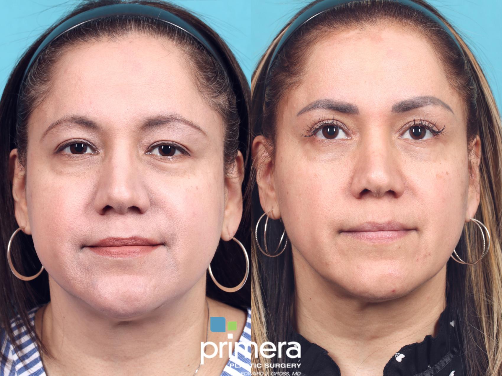 Before & After Blepharoplasty Case 784 Front View in Orlando, Florida