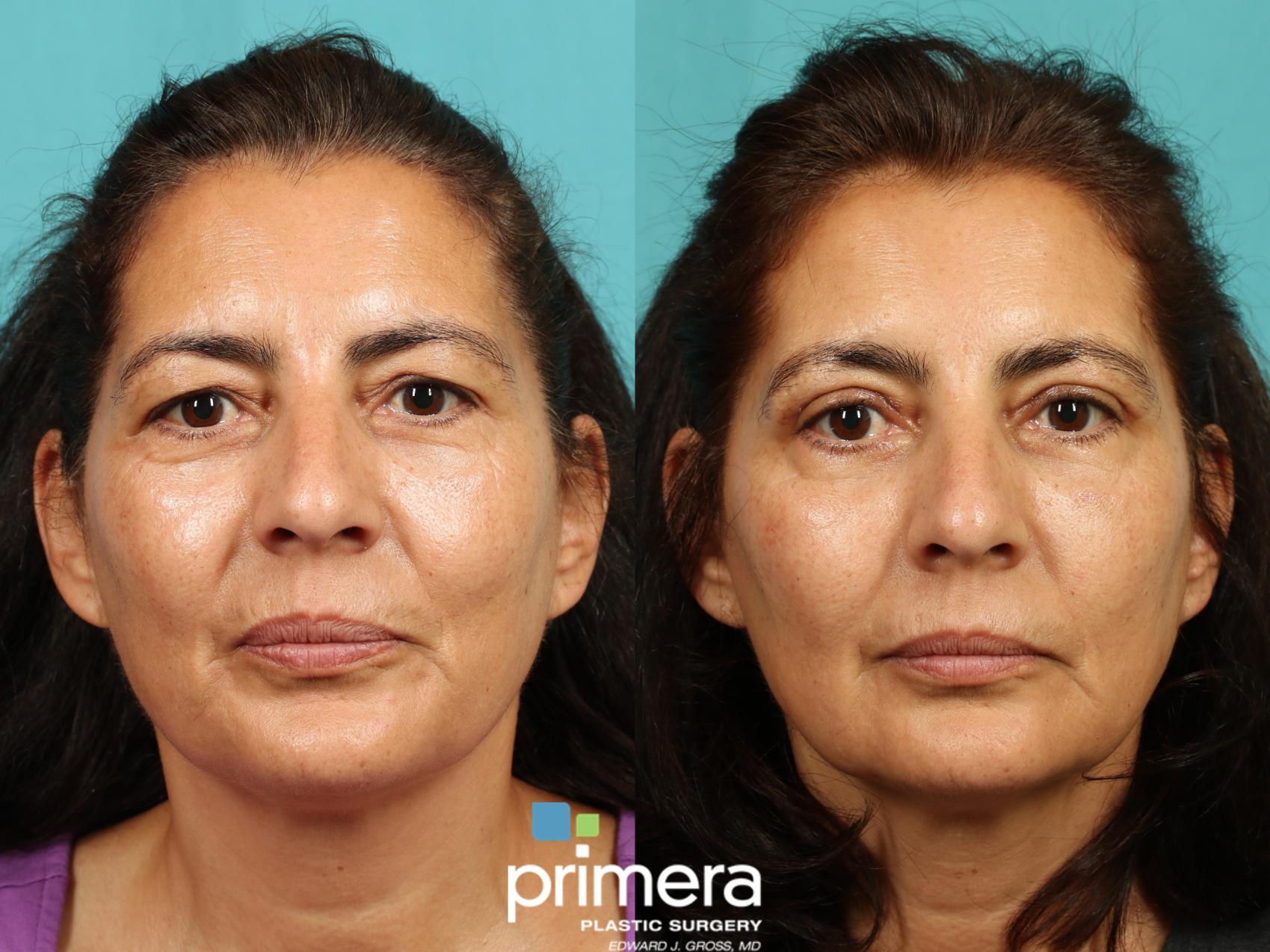 Before & After Blepharoplasty Case 838 Front View in Orlando, Florida