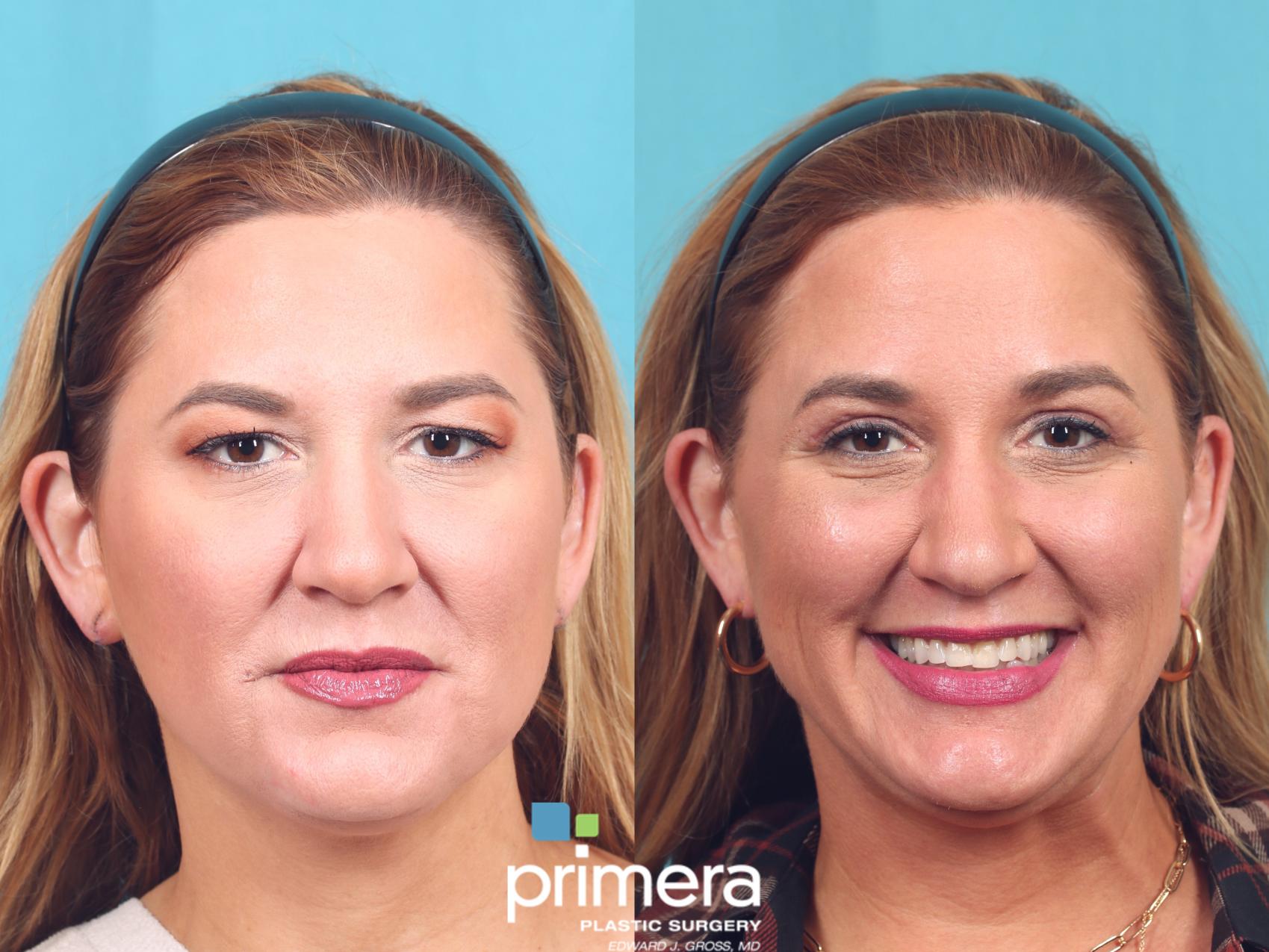 Before & After Blepharoplasty Case 839 Front View in Orlando, Florida