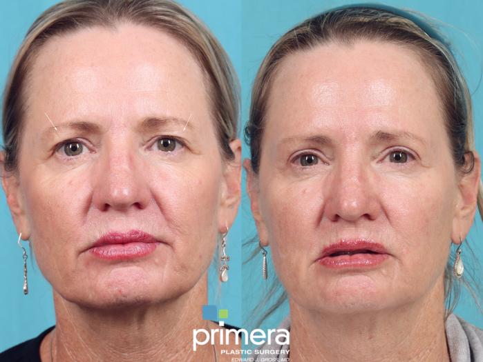 Before & After Endoscopic Forehead Lift Case 860 Front View in Orlando, Florida