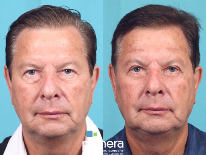 Before & After Brow Lift Case 876 Front View in Orlando, Florida