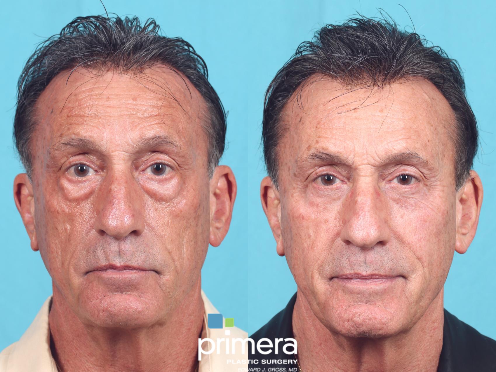 Before & After Blepharoplasty Case 898 Front View in Orlando, Florida