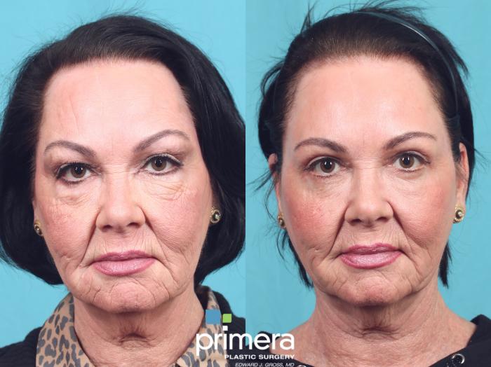 Before & After Blepharoplasty Case 921 Front View in Orlando, Florida