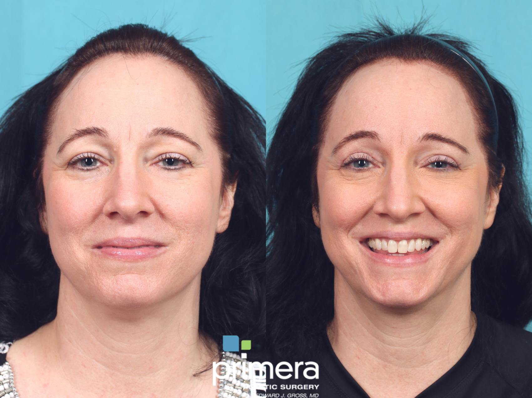 Before & After Blepharoplasty Case 927 Front View in Orlando, Florida