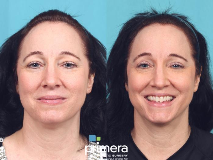 Before & After Laser Skin Resurfacing (DOT CO2) Case 927 Front View in Orlando, Florida