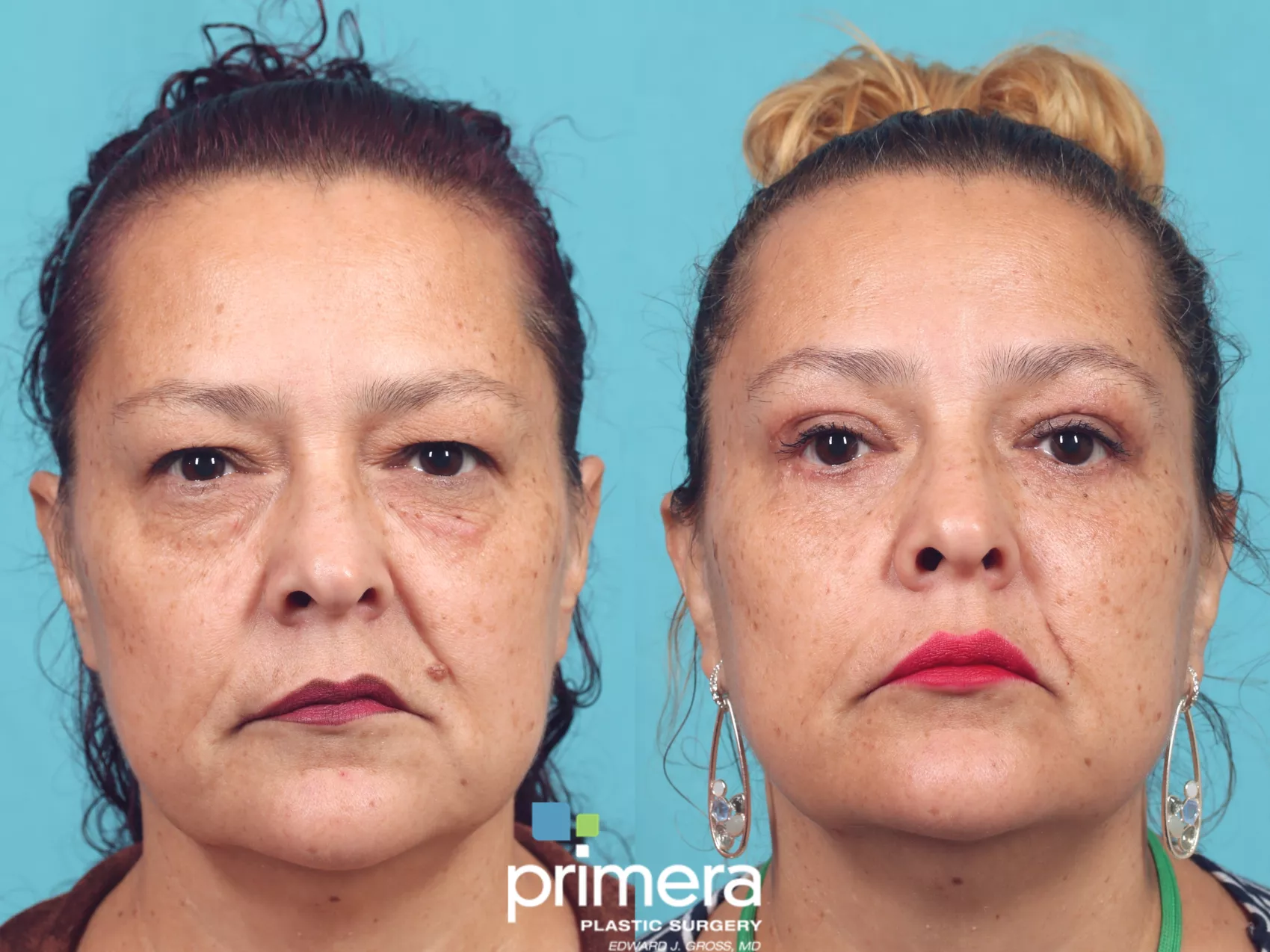 blepharoplasty-933-front-