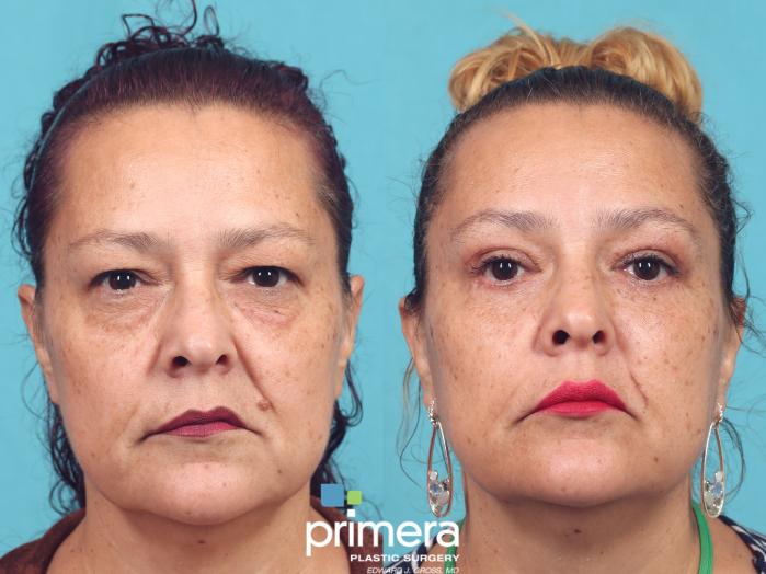 Before & After Blepharoplasty Case 933 Front View in Orlando, Florida
