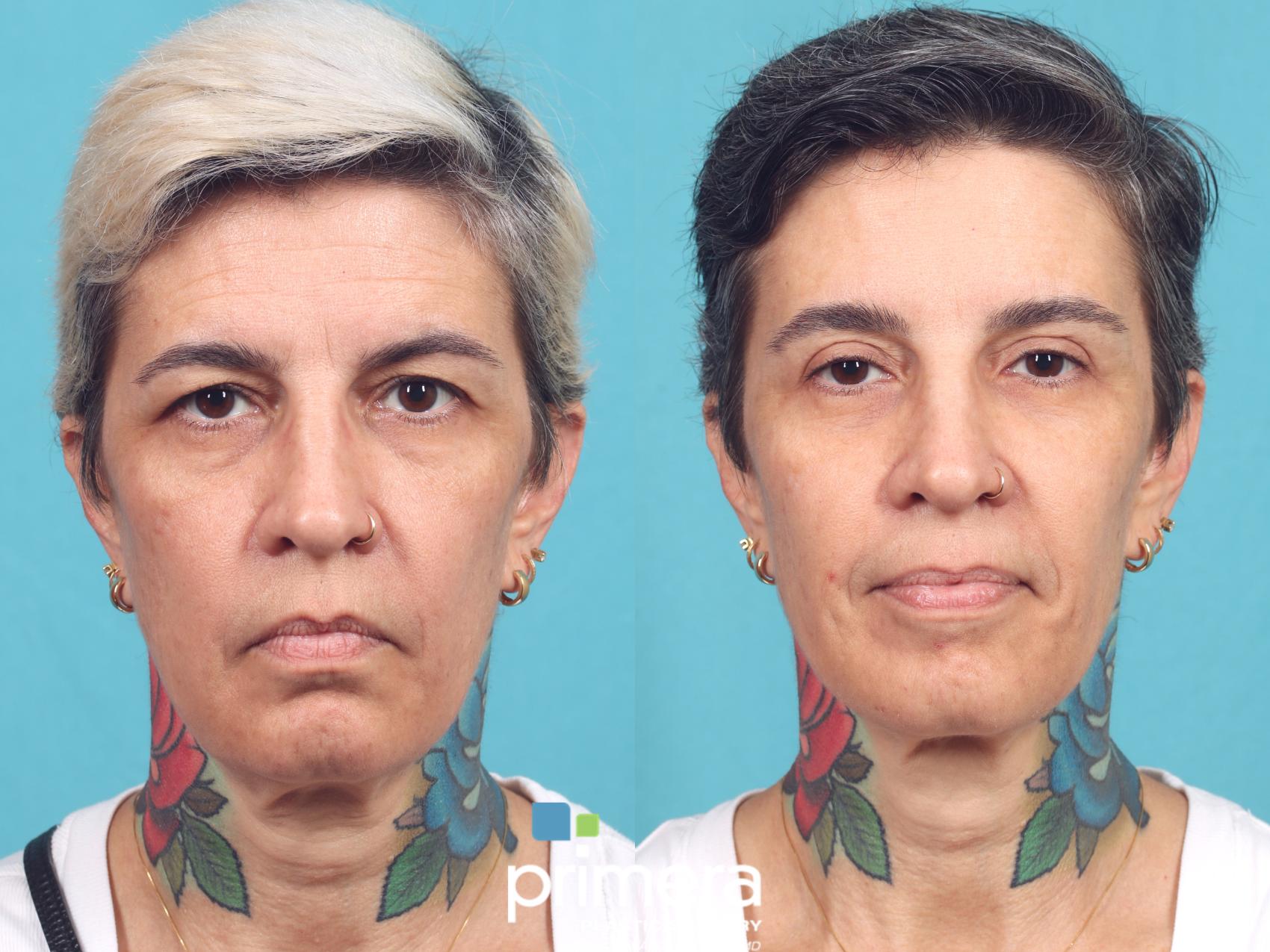 Before & After Blepharoplasty Case 938 Front View in Orlando, Florida