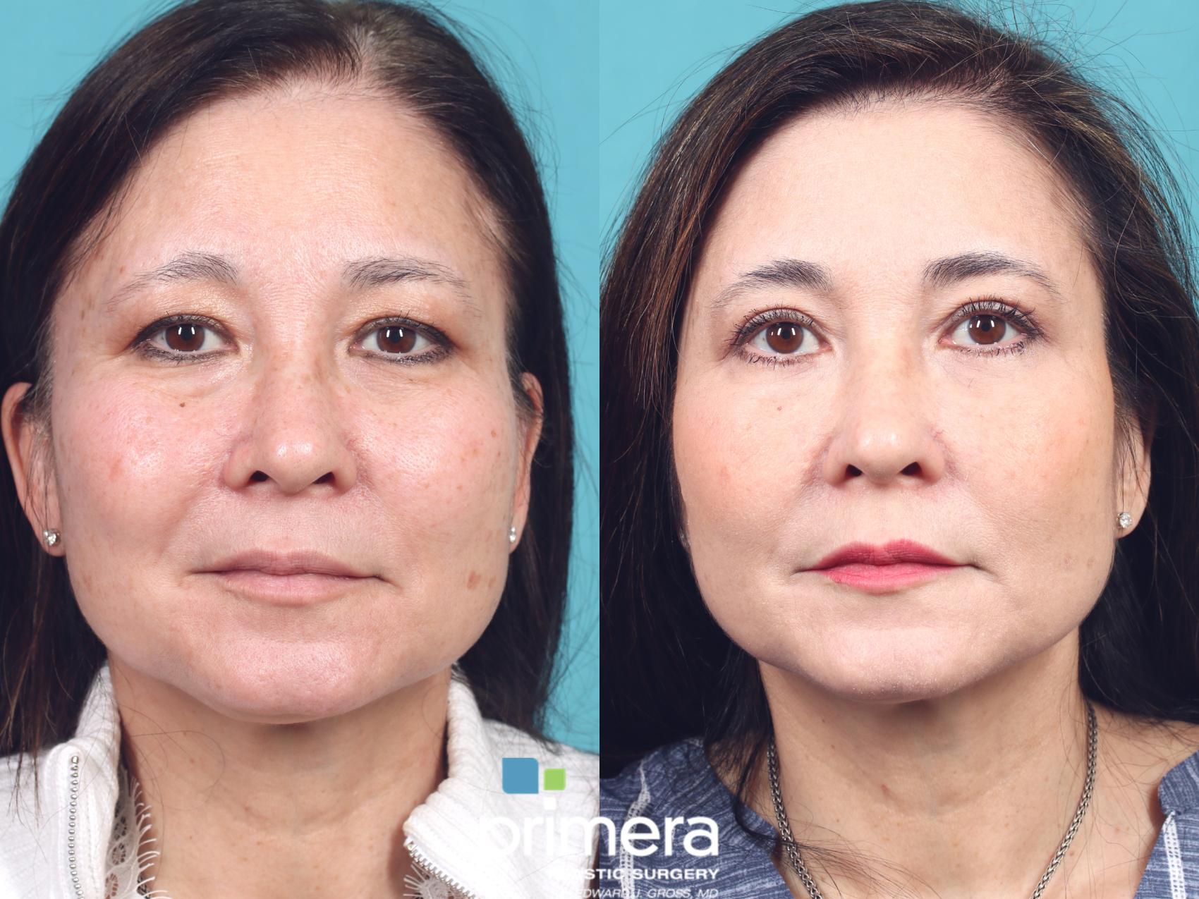 Before & After Blepharoplasty Case 941 Front View in Orlando, Florida