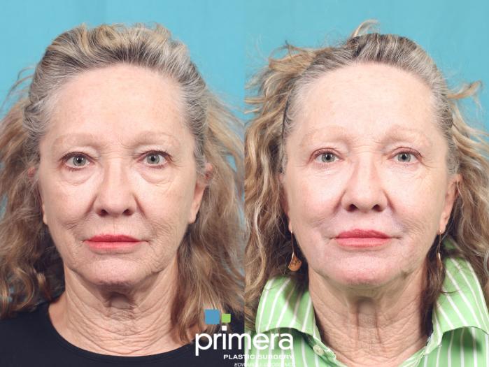 Before & After Blepharoplasty Case 953 Front View in Orlando, Florida