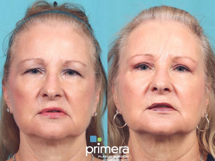 Before & After Blepharoplasty Case 960 Front View in Orlando, Florida