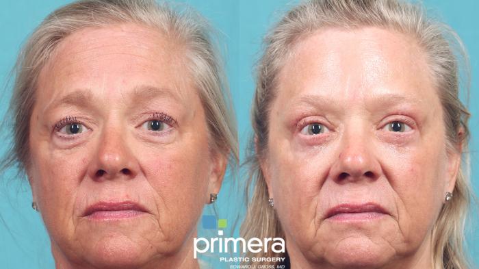 Before & After Blepharoplasty Case 965 Front View in Orlando, Florida
