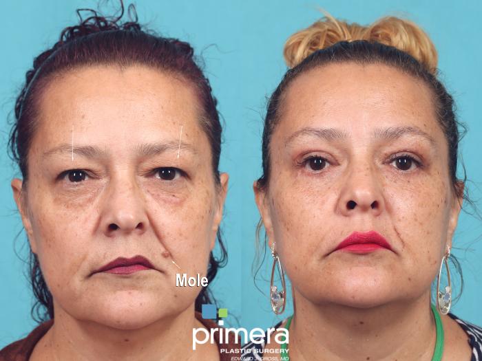 Before & After Laser Skin Resurfacing (DOT CO2) Case 967 Front View in Orlando, Florida