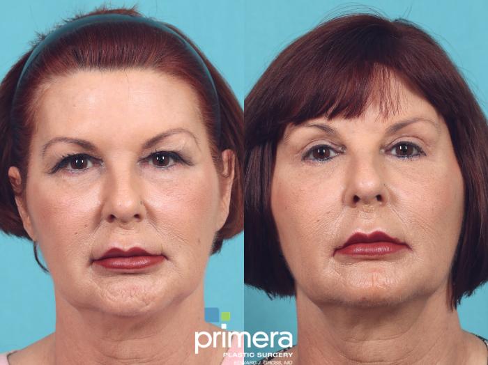 Before & After Blepharoplasty Case 969 Front View in Orlando, Florida