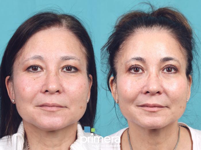 Before & After Blepharoplasty Case 973 Front View in Orlando, Florida