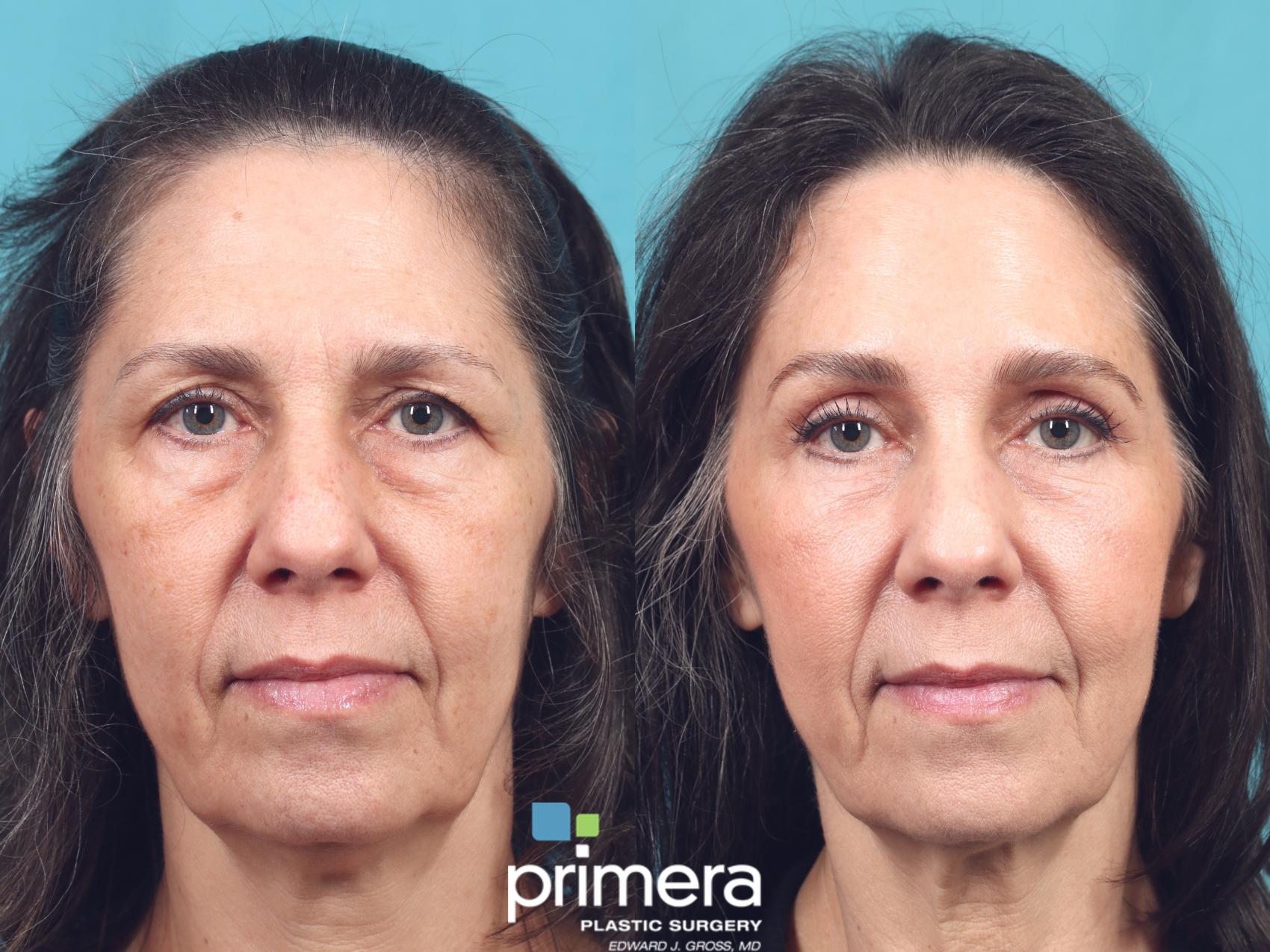 Before & After Blepharoplasty Case 978 Front View in Orlando, Florida