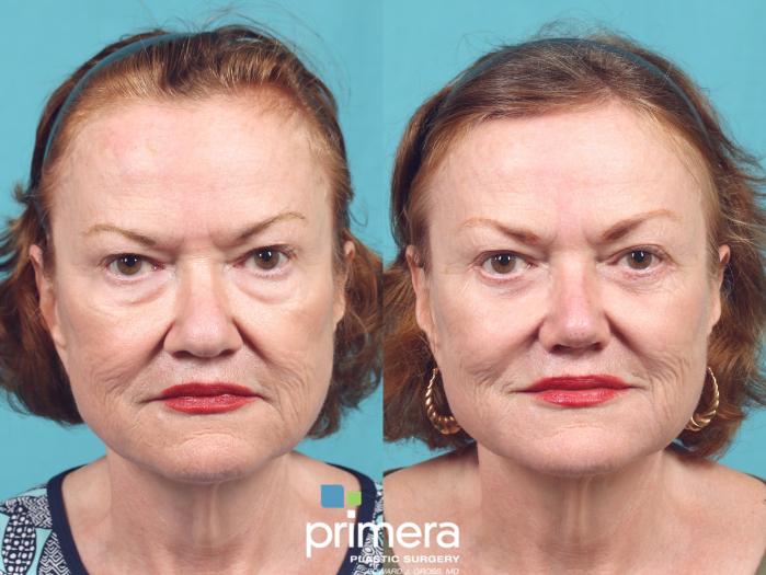 Before & After Blepharoplasty Case 983 Front View in Orlando, Florida