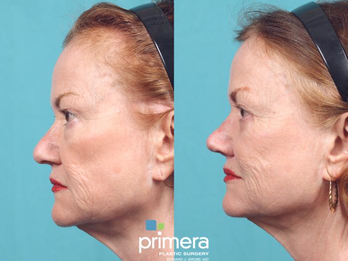 Before & After Rhinoplasty Case 983 Left Side View in Orlando, Florida