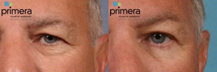 Before & After Brow Lift Case 99 view-1 View in Orlando, Florida