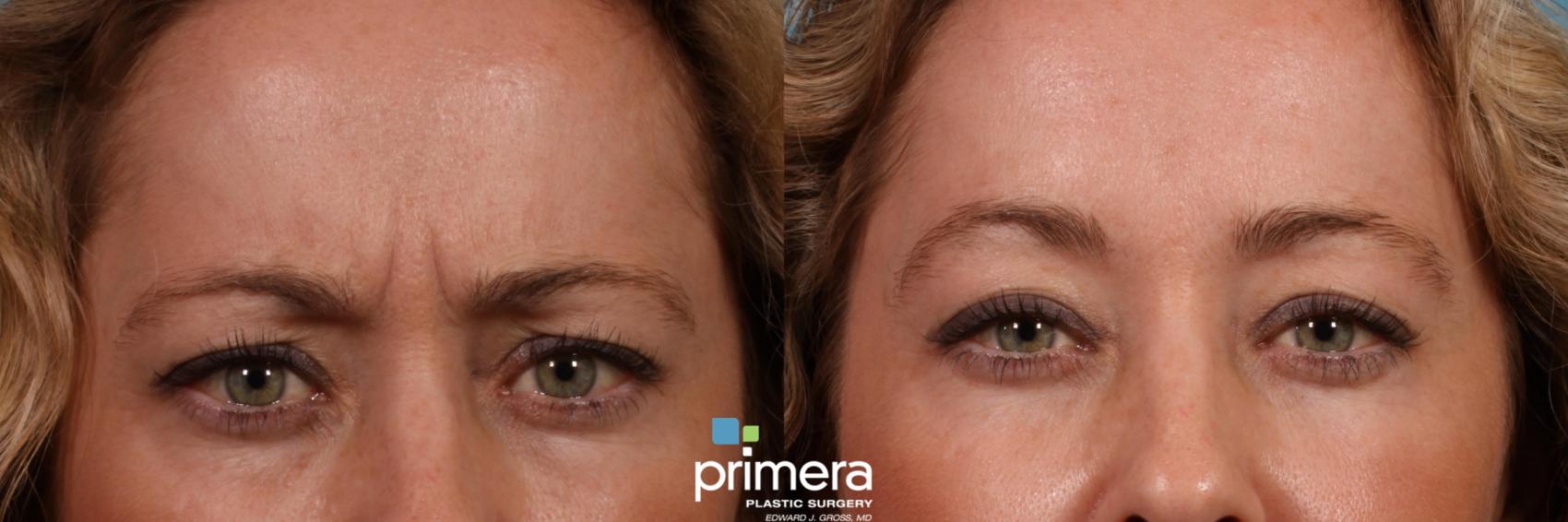 Before & After BOTOX® Cosmetic Case 431 view-1 View in Orlando, Florida