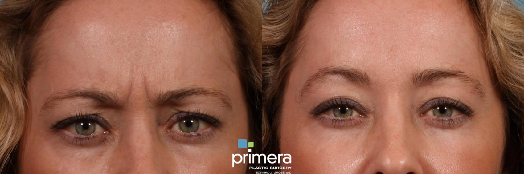 Before & After Brow Lift Case 431 view-1 View in Orlando, Florida