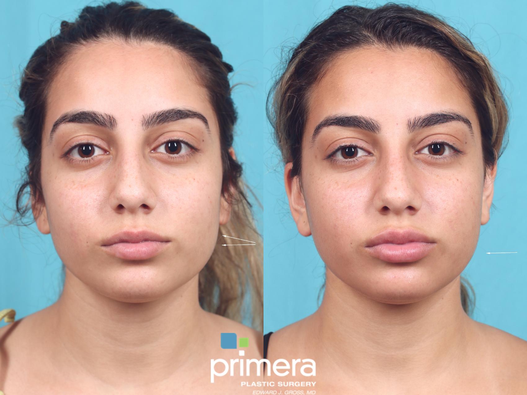 BOTOX® Cosmetic Before and After Pictures Case   Orlando