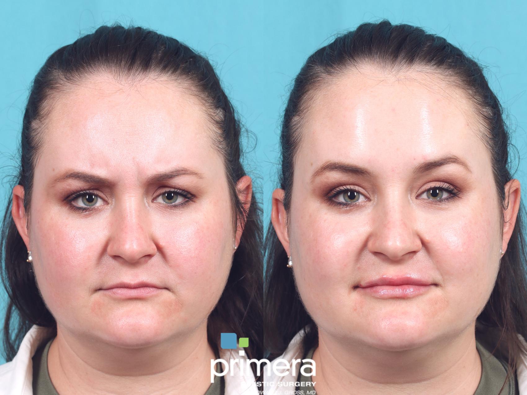 Botox Volbella Primera Plastic Surgery Orlando, FL