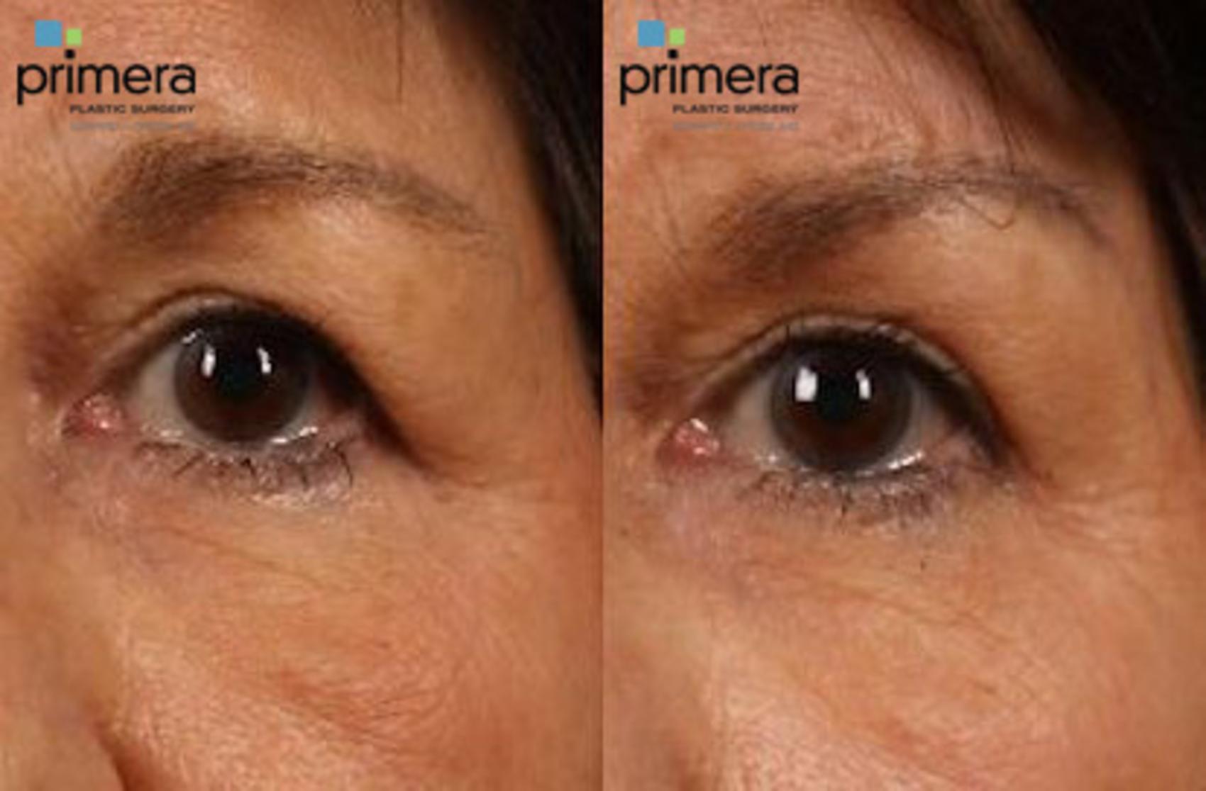 Brow Lift Before After Photo Gallery Orlando Florida Primera Plastic Surgery