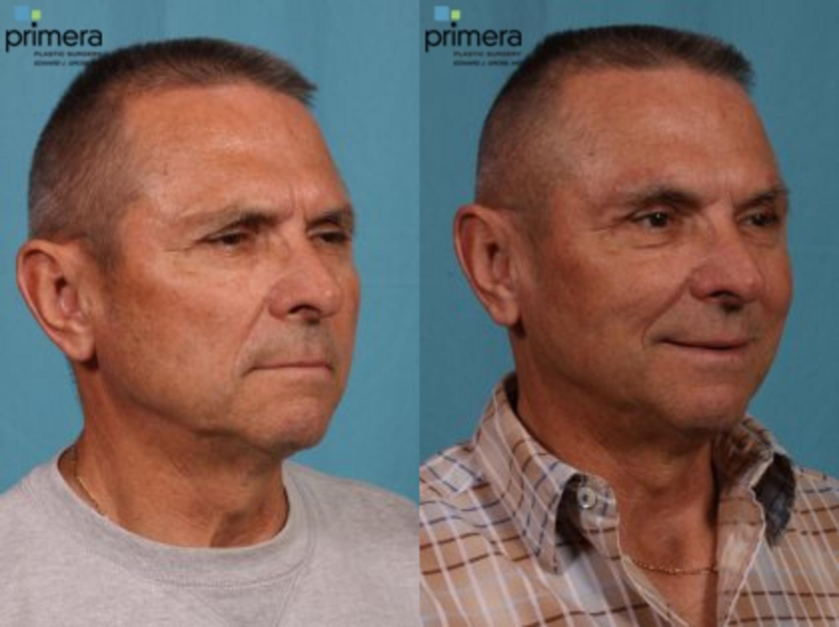 Brow Lift Before After Photo Gallery Orlando Florida Primera Plastic Surgery