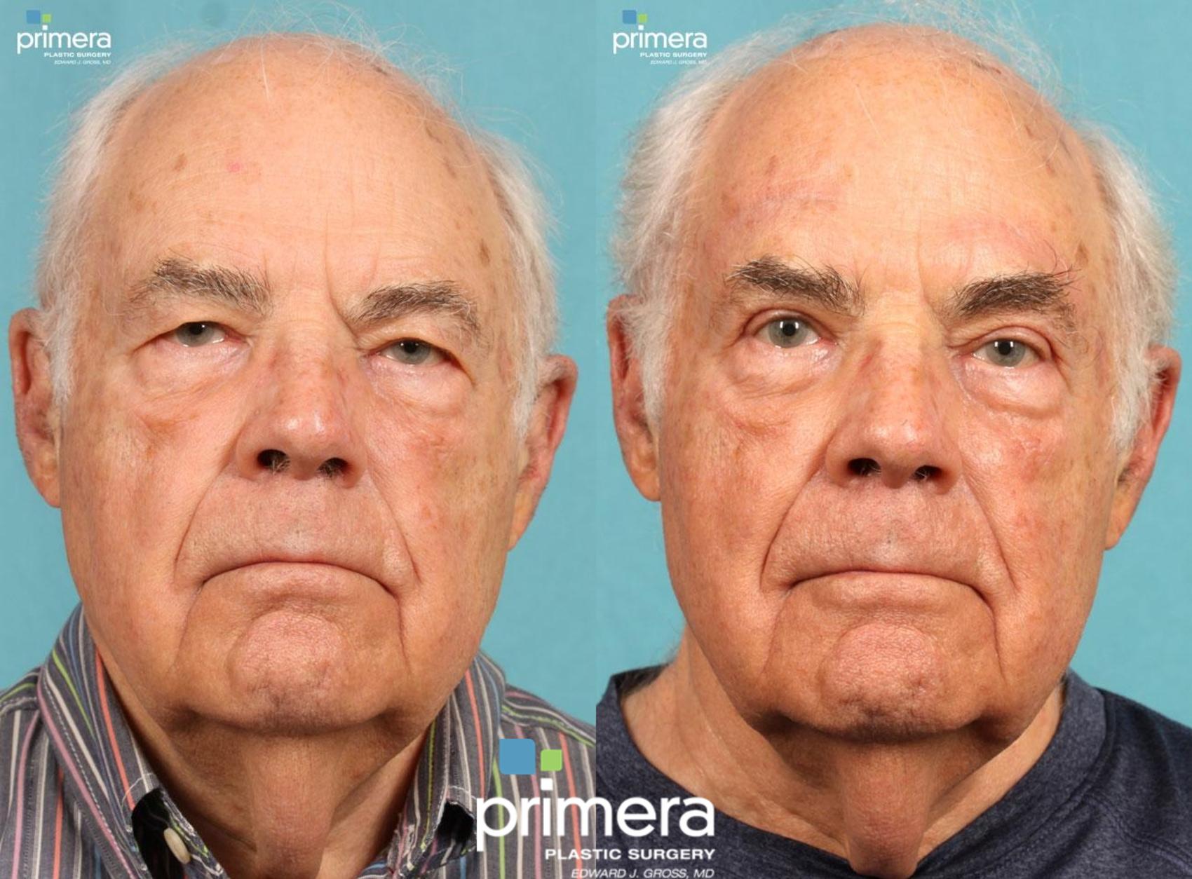 Before & After Blepharoplasty Case 429 view-1 View in Orlando, Florida