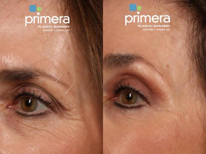 Before & After Brow Lift Case 557 view-1 View in Orlando, Florida