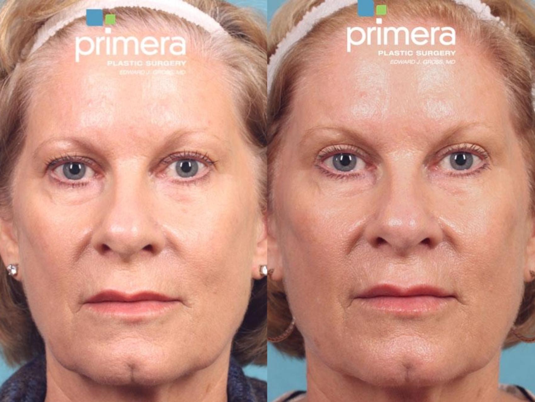 Before & After Blepharoplasty Case 571 view-1 View in Orlando, Florida