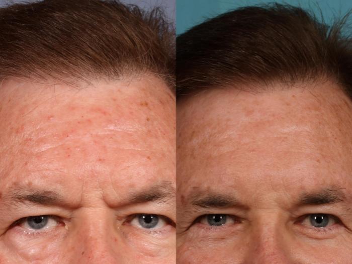 Before & After Blepharoplasty Case 75 view-1 View in Orlando, Florida