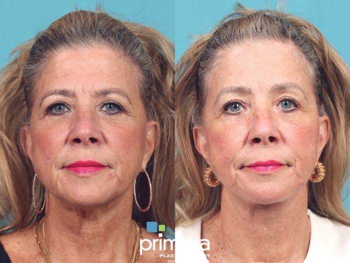 Before & After Brow Lift Case 982 Front View in Orlando, Florida