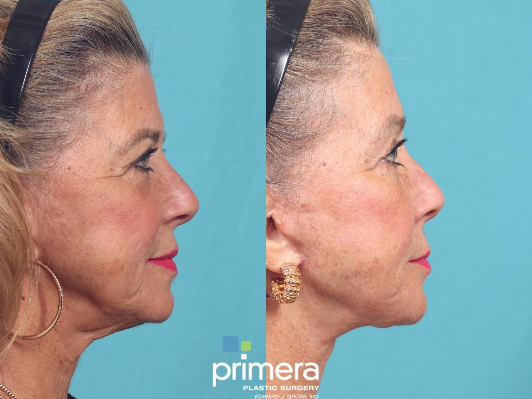 Before & After Brow Lift Case 982 Right Side View in Orlando, Florida