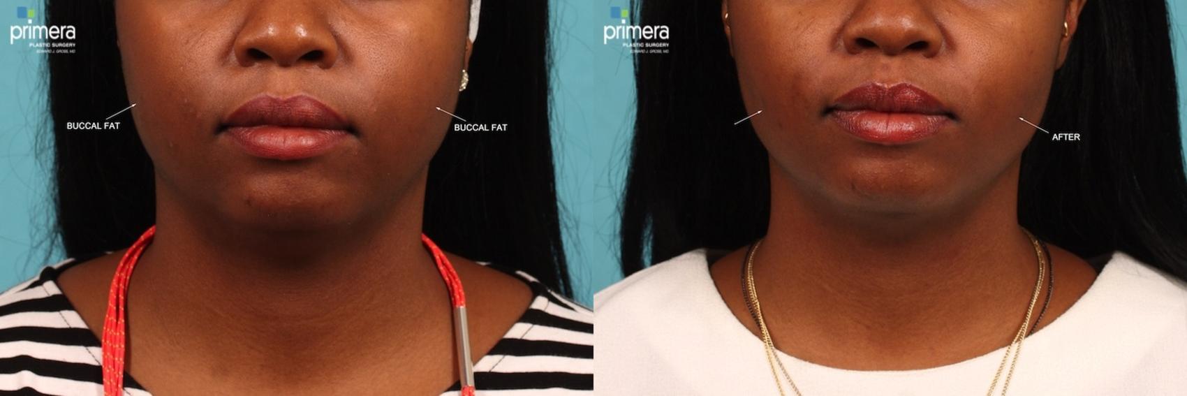 Before & After Neck & Face Liposuction Case 393 view-1 View in Orlando, Florida